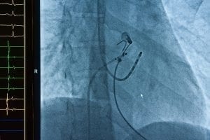coronary heart stent , Ablation operation