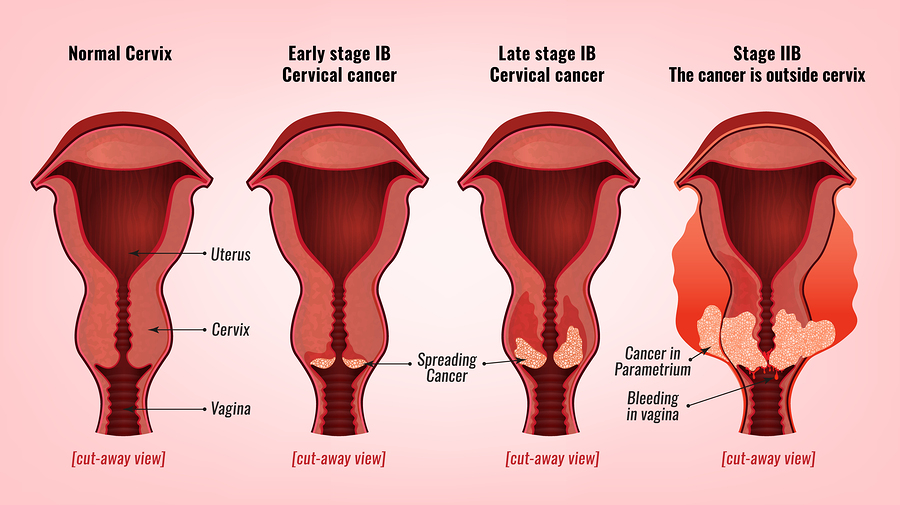 Hpv treatment bleeding, Spotting the Signs of Uterine Cancer benign cancer icd 10