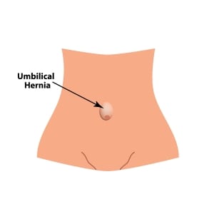 Umbilical Hernia illustartion