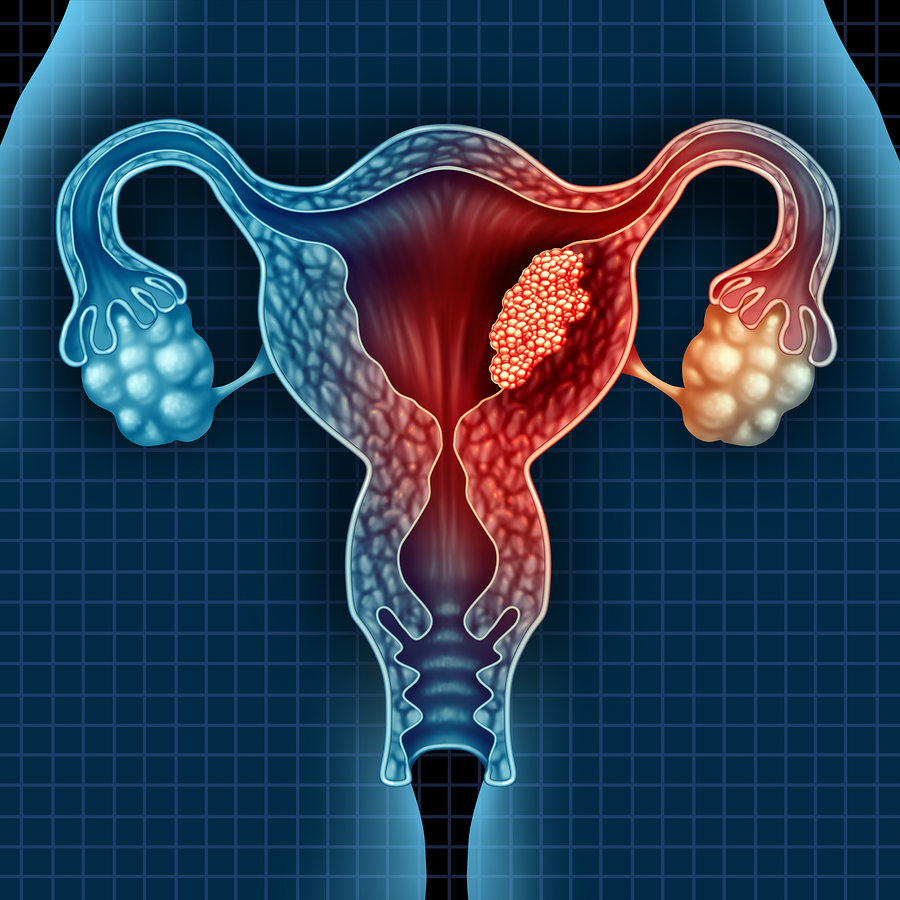 endometrial-cancer-staging-primary-tumor-t-grepmed