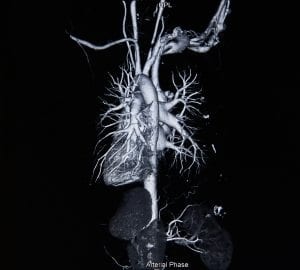 Virtual Coronary Angiography