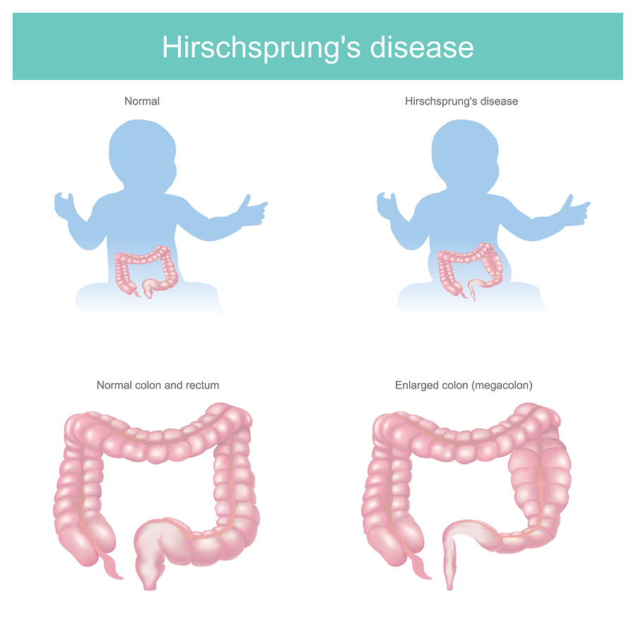 Treatment of Hirschsprung’s Disease in Children | Herzliya Medical