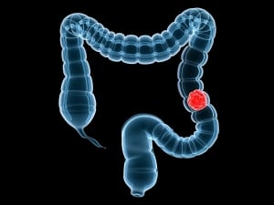 3d rendered illustration of a human colon with carcinoma St