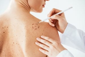 Dermatologist applying marks on skin
