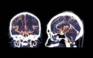 Cerebral angiography, Brain CT