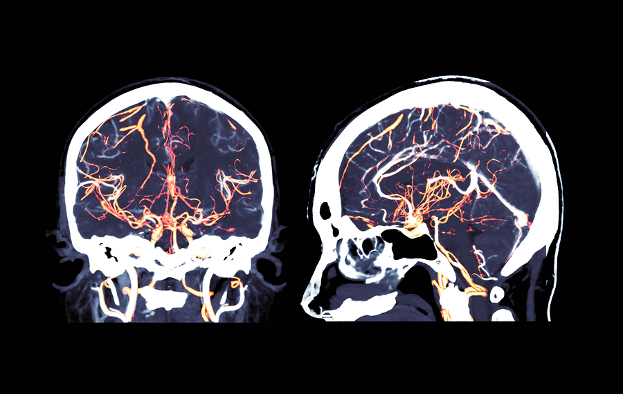 coronary-angiography-ct-coronary-angiography-procedure-complications