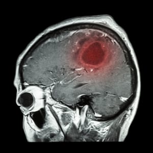 Brain tumer surgery, brain MRI