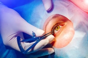 eye microsurgery, Eyelid speculum