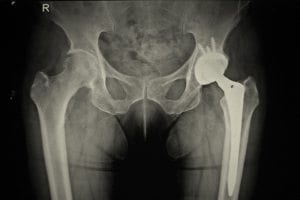X ray of a hip fracture