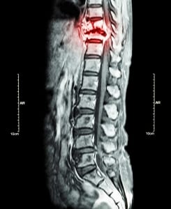 cancer spread to the spine